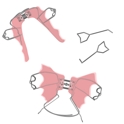 Parts of a palatal expander outside of mouth