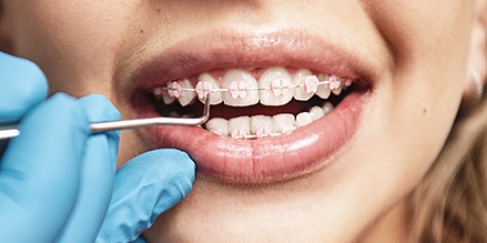 Orthodontist fixing a loose braces wire