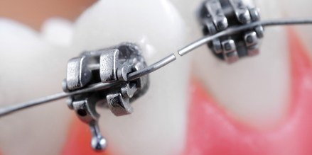 Closeup of smile with protruding braces wire