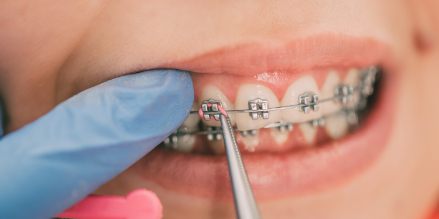 Orthodontist repairing a loose braces bracket