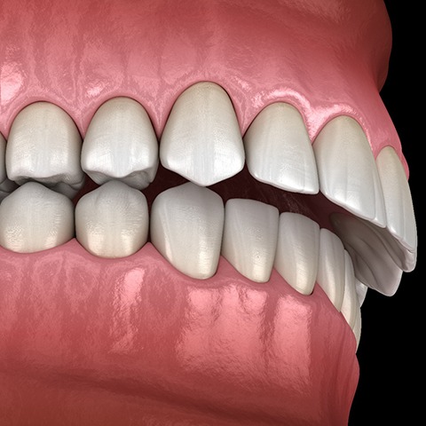 Illustration of an overbite