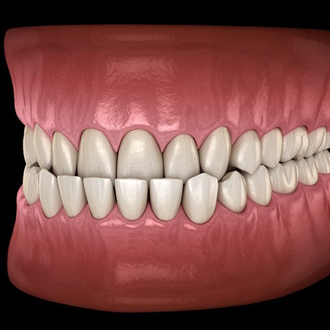 Illustration of an underbite