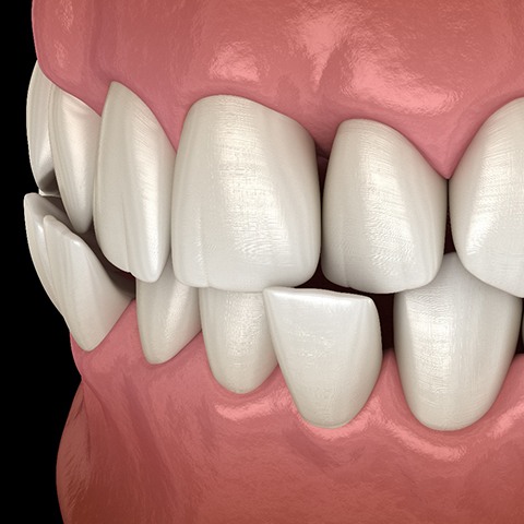 Illustration of a crossbite