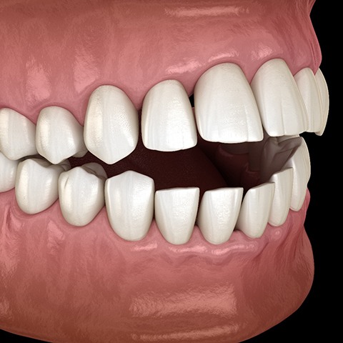 Illustration of an open bite