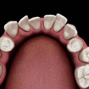 Illustration of crooked teeth, which Invisalign® may be able to correct