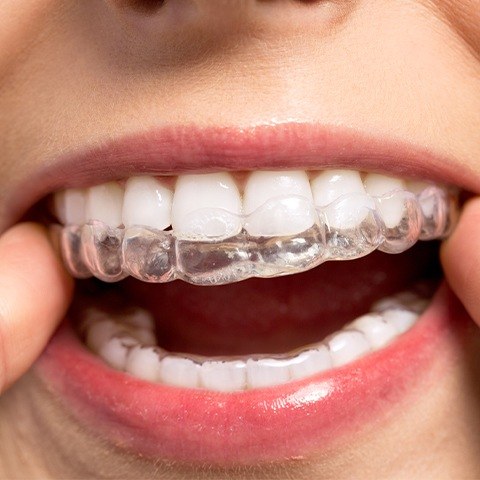 Closeup of patient positioning Invisalign® tray