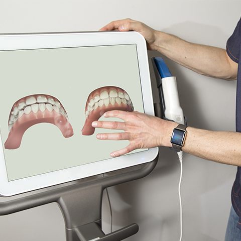 iTero Element integrate Invislaign treatment plan on computer screen