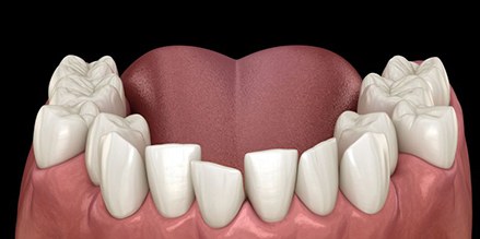 Illustration of crowded, crooked teeth