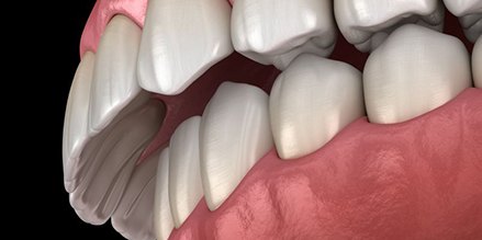 Illustration of an overbite against dark background