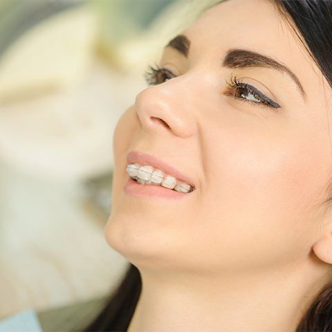 Woman with 3 M clarity clear and ceramic braces