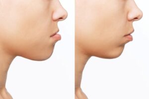 Before and after photo of patient's underbite