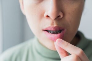 Person with braces pulling their lip to show mouth sore 
